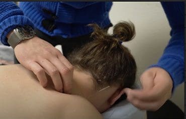 Acupuncture treatment for neck pain. Patient getting an acupuncture needle placed in lower neck by acupuncturist