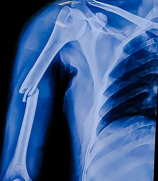 An X-ray showing a broken arm bone.