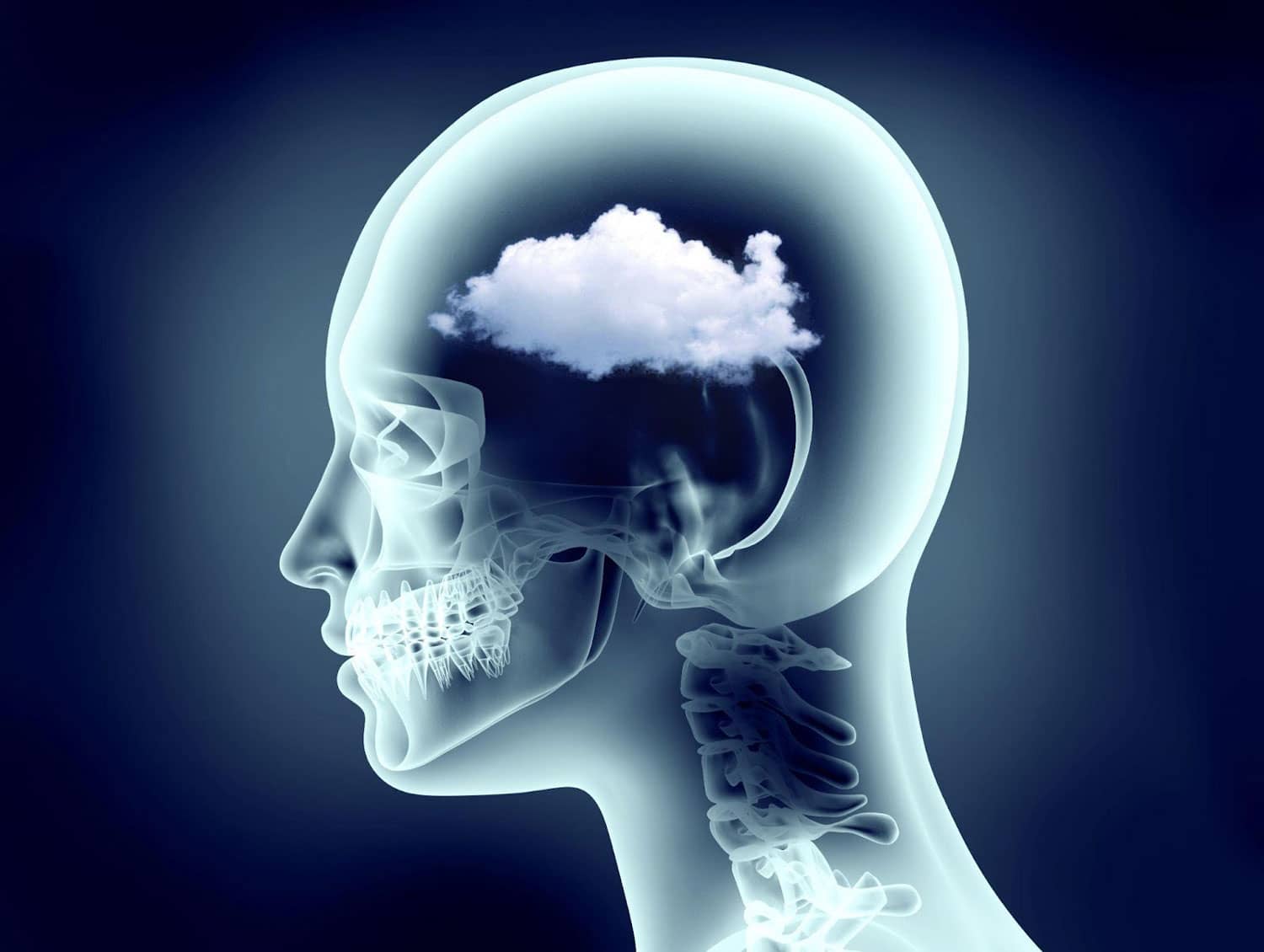 An artists rendition of an X-ray of the human head in profile. A cloud hovers in the brain to symbolize brain fog.
