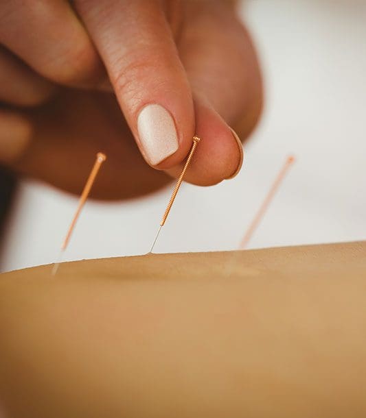A close up of Acupuncture needles being applied to the skin.