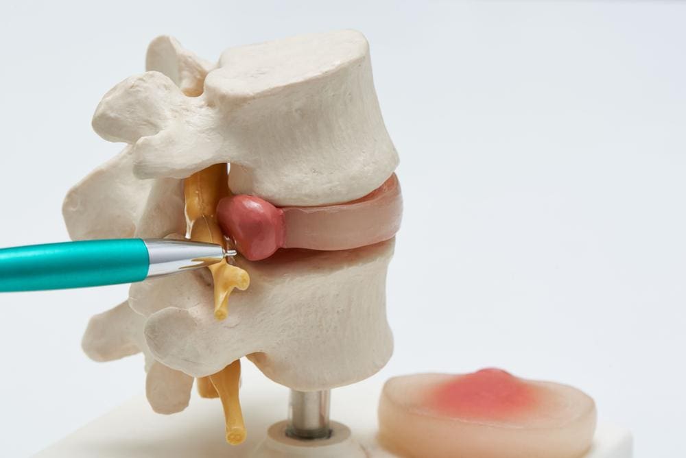 A model of the spine demonstrating a herniated disc.
