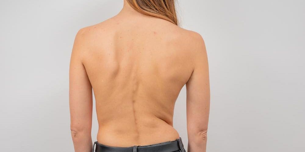 An adult woman with scoliosis.
