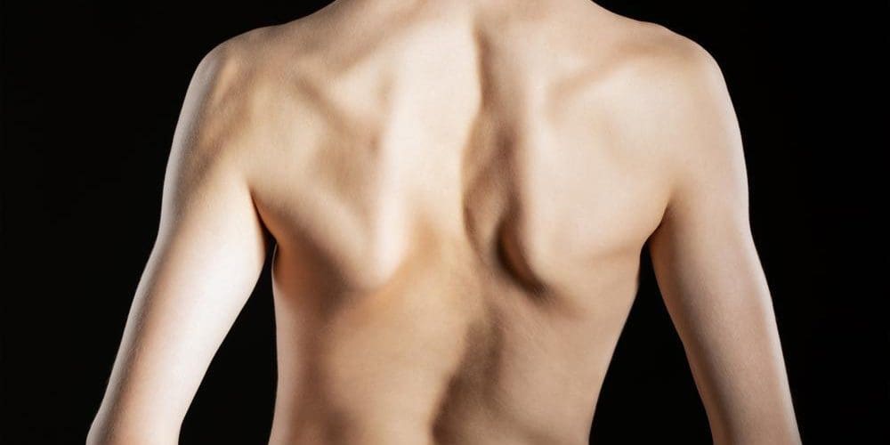 A man's back with scoliosis.