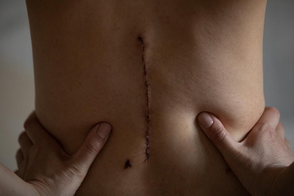 A back surgery scar.