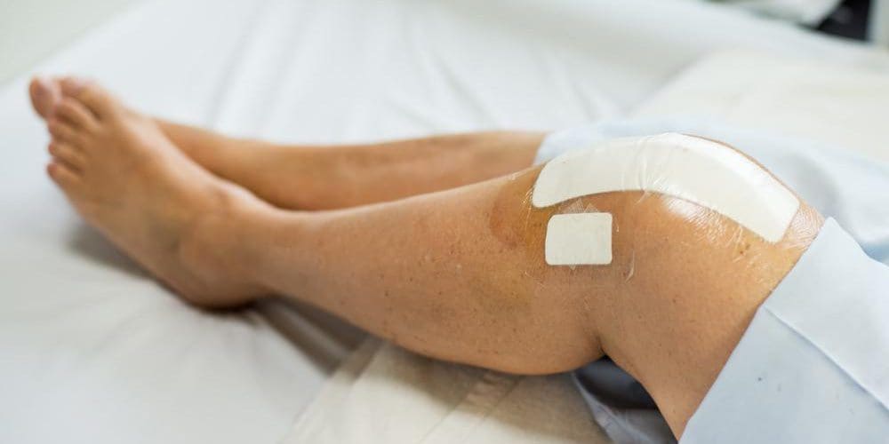 A woman's bandaged knee in a hospital bed after a knee replacement.