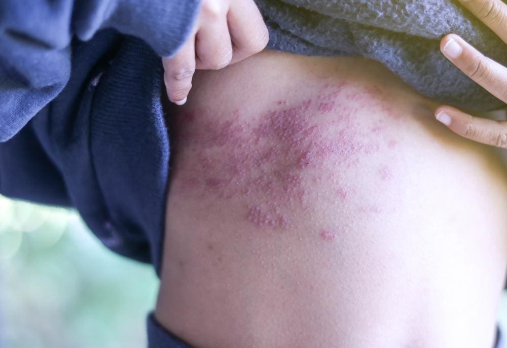 A man has a shingles rash on his ribs and chest area. 