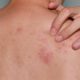 Managing Shingles Pain Naturally with Chiropractic Care