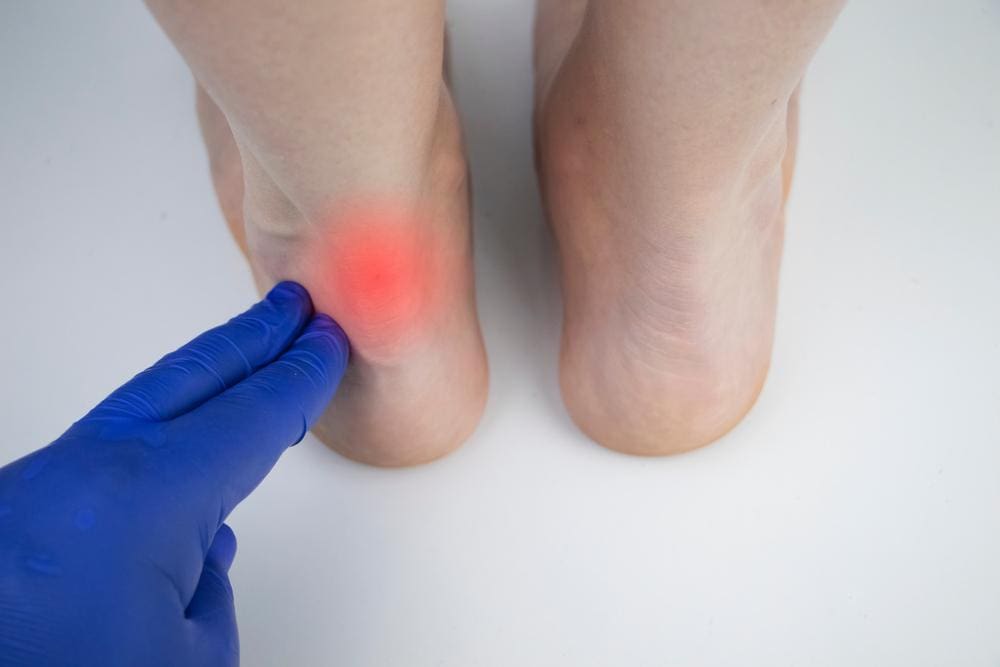 Home remedies for hot sale achilles heel