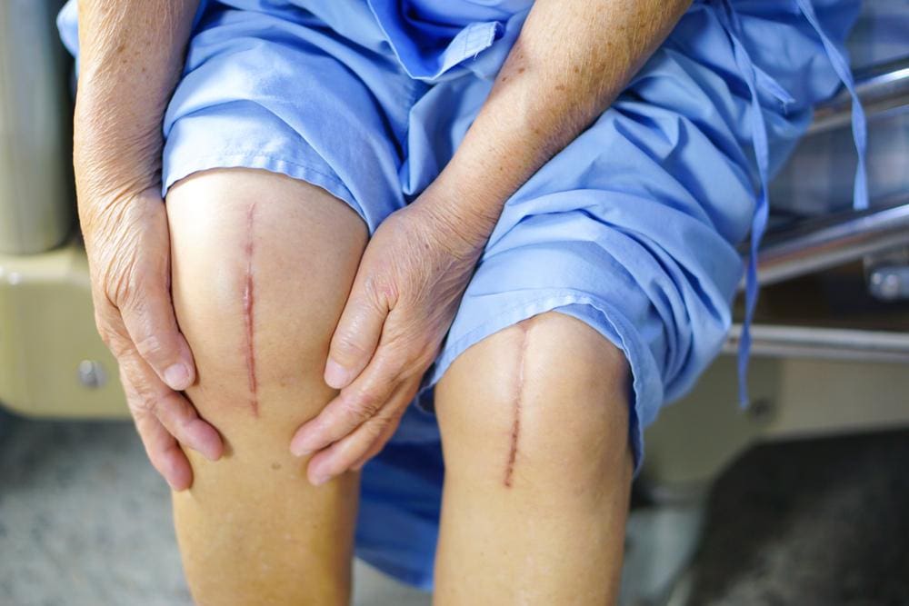 A woman's knee replacement scars.