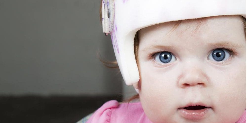 Young baby wearing cranial shaping helmet