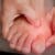 Chiropractic Care for Bunions