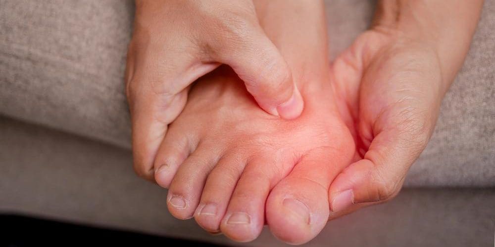 Woman with bunion holding her foot.