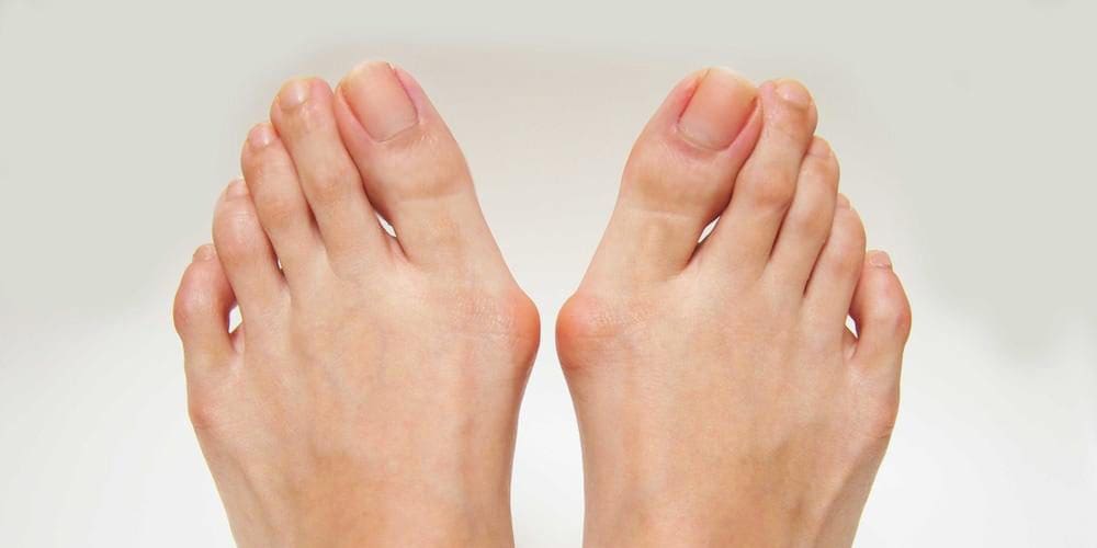 Pair of feed with red, inflamed bunions.
