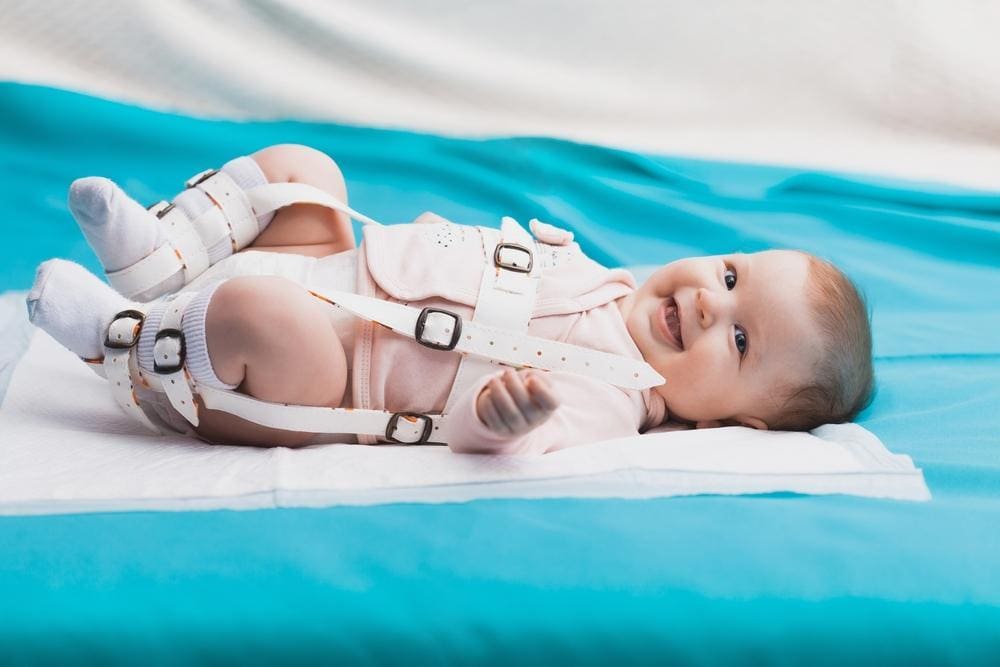 Baby wearing a Pavlik harness to correct hip dysplasia.