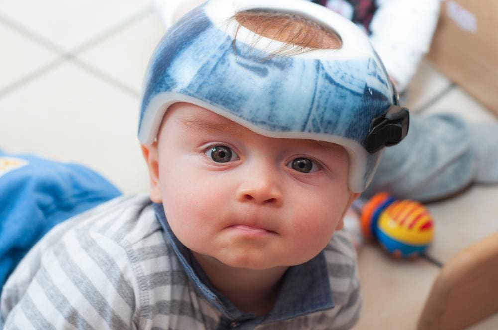 Infant wearing an orthopedic helmet.