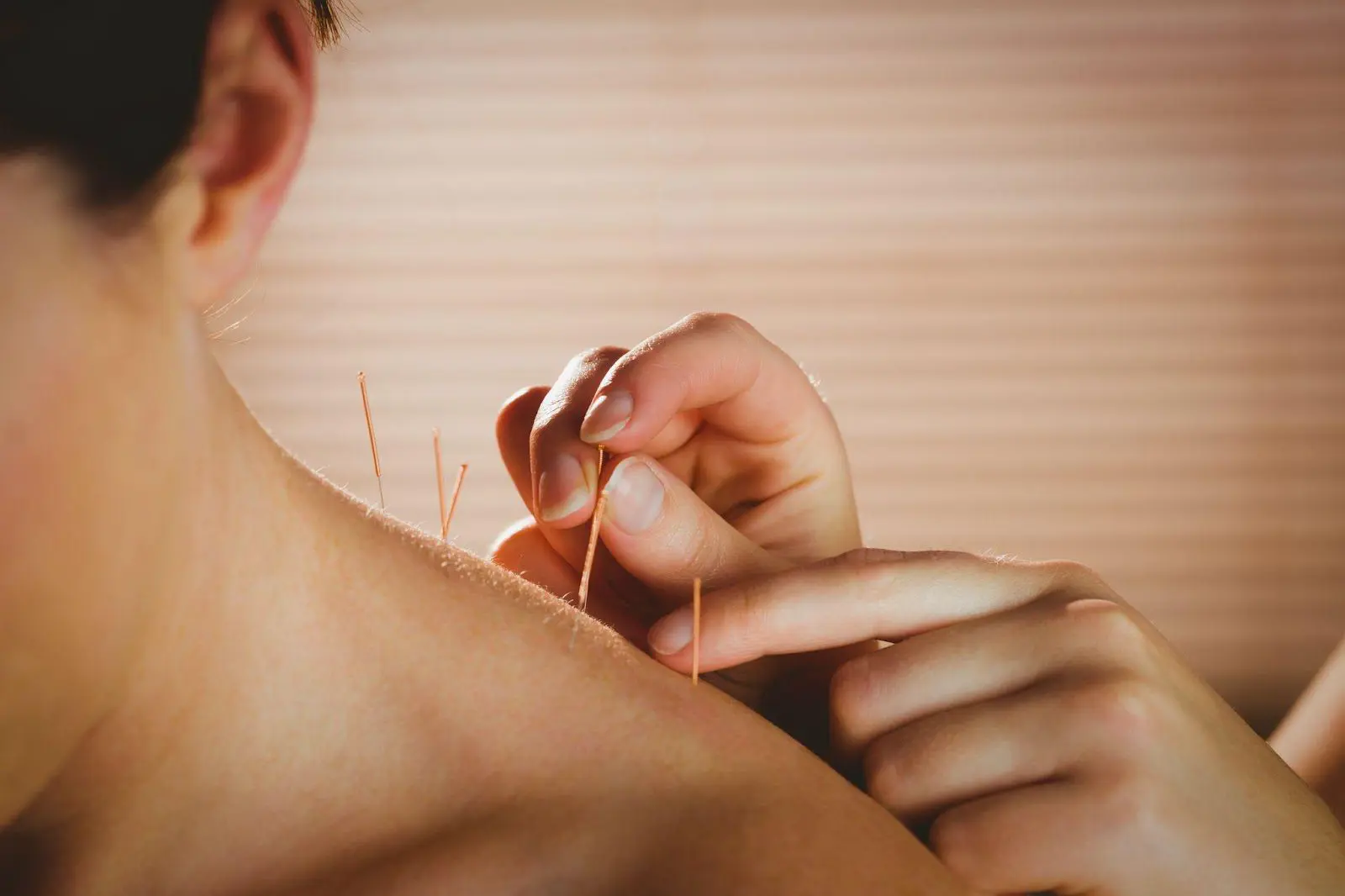 Young woman getting acupuncture on her shoulder.